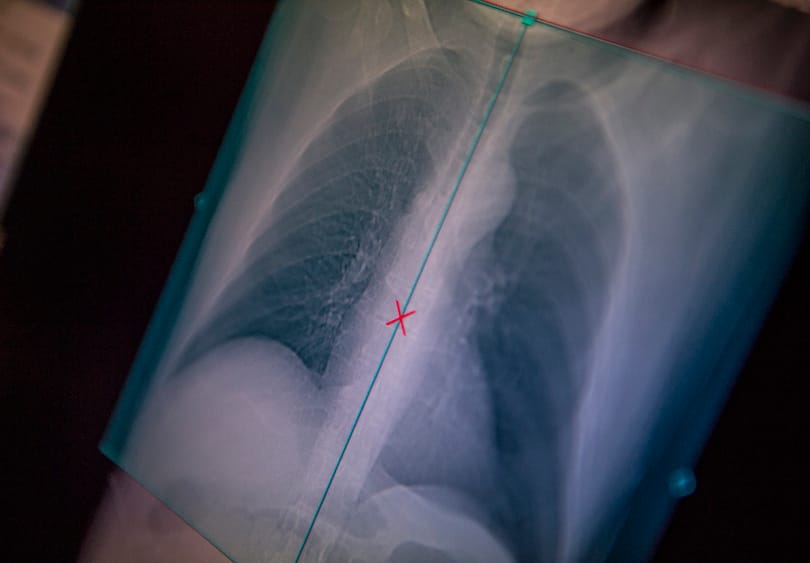 96%-os pontosság: izzadó ujjból mondják meg az orvosok, szedi-e a beteg az antibiotikumot