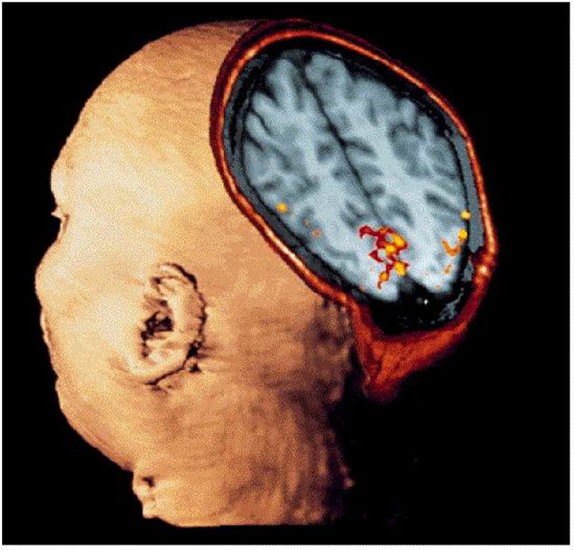 Miért okoz szédülést az MRI? 