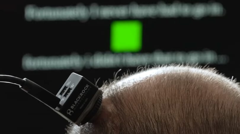 Hangot ad a beszédképtelenné vált betegeknek egy új agyi chip, egy emberbe már beültették – videó
