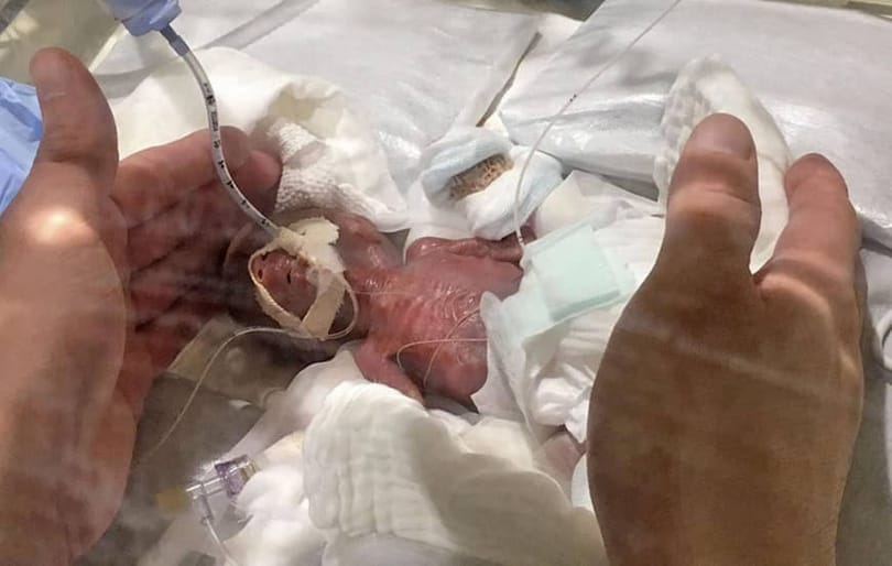 Két tenyérben elfért, olyan kis súllyal jött világra az újszülött, aki fél év kezelés után hazaengedtek a kórházból