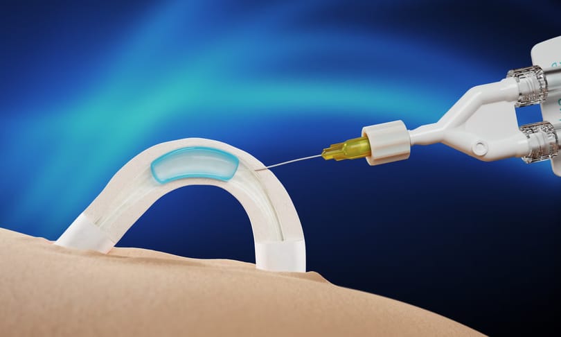 Jöhet a hormonmentes, férfi fogamzásgátló-implantátum, ami két éven át fejti ki hatását