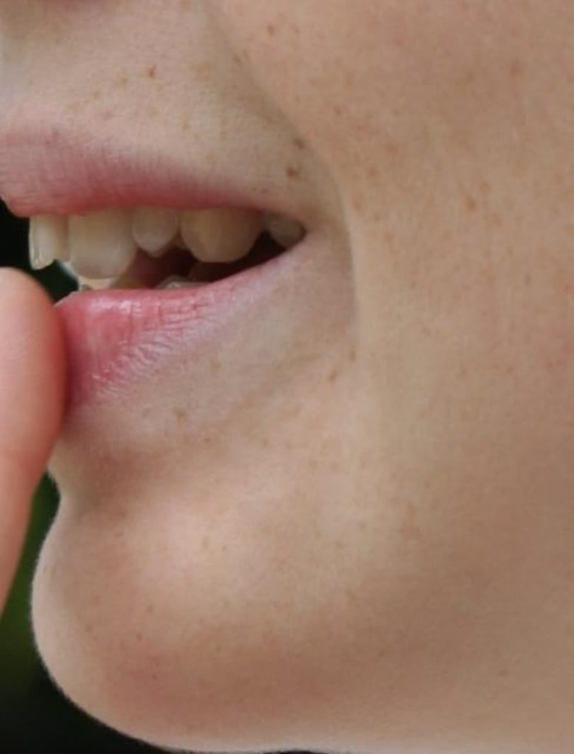 Napi tipp: így bánhatunk el a herpesszel