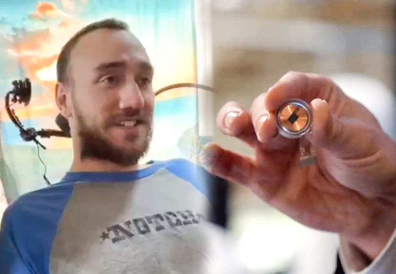 Probléma támadt a Neuralink első, emberbe ültetett agyi chipjénél, elkezdtek visszahúzódni a szálai
