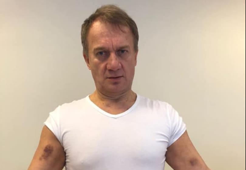 Varju László feljelent és megmutatta a véraláfutásait