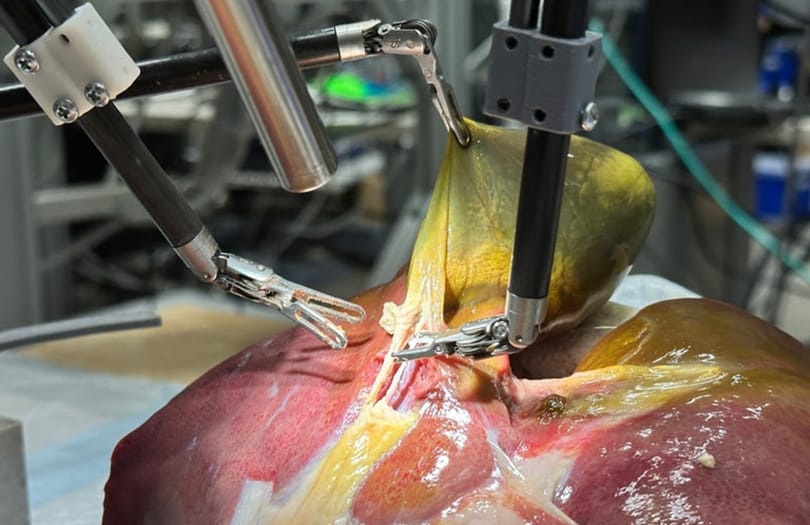 100%-os pontossággal, emberi beavatkozás nélkül műtötte ki az epehólyagot a mesterséges intelligenciával hajtott robotsebész