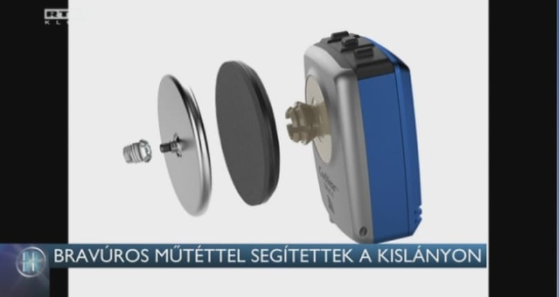 Bravúros műtéttel javították egy kislányt hallását Budapesten