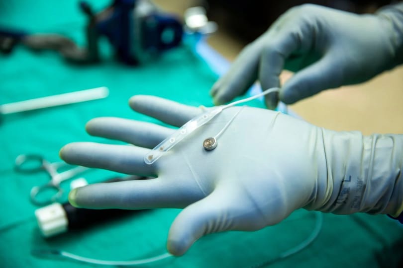 Kipróbálták az első agyi chipet, amely vezeték nélkül kapcsolja össze az embert egy számítógéppel