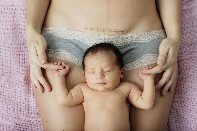 Aggódni kell amiatt, amire most rájöttek a császármetszésekről?