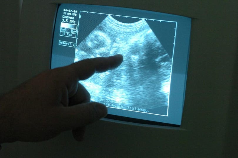 A meg nem született ikertestvérét műtötték ki egy egyéves kislány agyából kínai orvosok