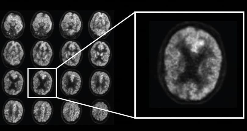 Van egy program, ami 6 évvel az orvosok előtt, eddig 100%-ban megmondta, kit fenyeget az Alzheimer-kór