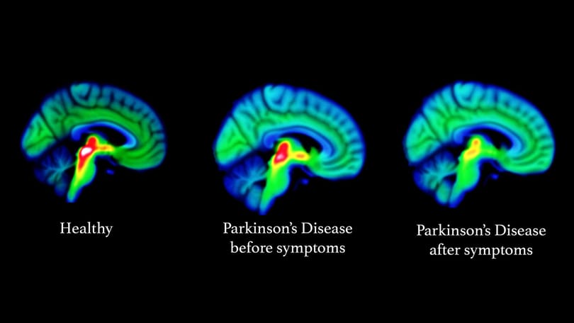15-20 évvel korábban is látszik: megtalálták a Parkinson-kór legkorábbi jeleit az agyban