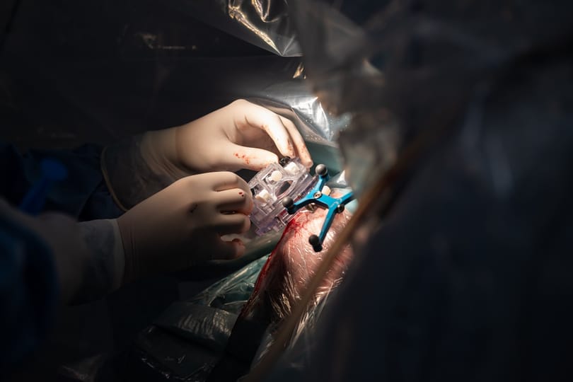 A világon ötödikként ültettek be egy új eszközt Szegeden egy idős, Parkinson-kórban szenvedő betegnek