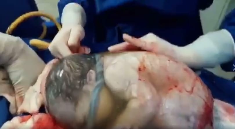 80 ezer szülésből 1 ilyen, ezért lett sztár egy spanyol baba – videó