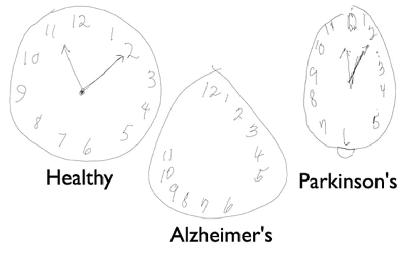 Csak rajzolni kell a képernyőre, és kiderítik, hogy érinti-e a Parkinson vagy az Alzheimer
