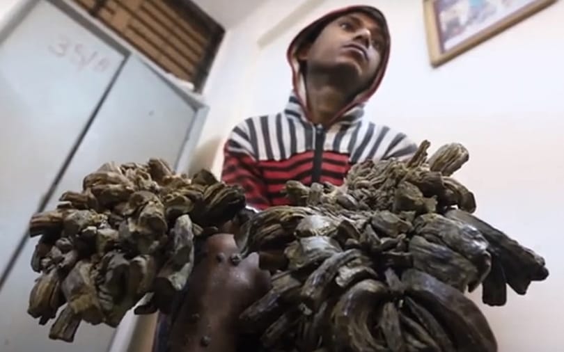 Megszabadítják a bangladesi faembert a kezére nőtt kéregtől