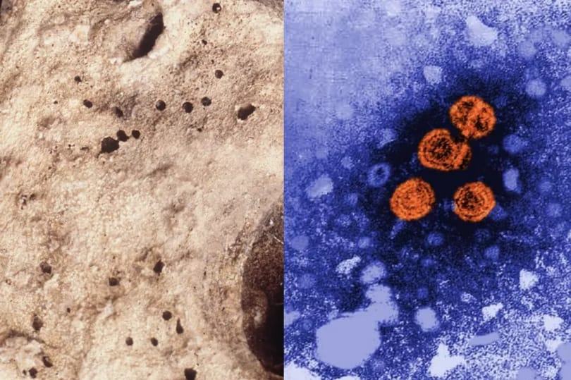 Egy 450 éve meghalt gyerek holttestében találhatták meg az eddigi legrégebbi hepatitis B vírust