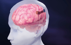 4096 elektródát ültettek egy emberi agyba, jelentős eredményt ért el a Neuralink riválisa