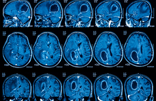 Egy éve rákmentes a gyógyíthatatlan tumorral diagnosztizált doktor a saját maga által kifejlesztett gyógymódnak köszönhetően