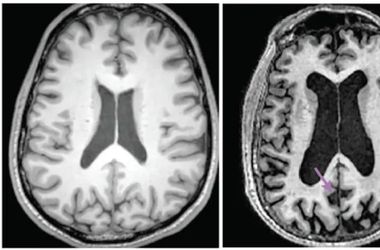 Szegedi kutatók megcsinálták: jöhet az Alzheimer-vérteszt