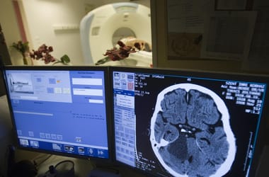 Természetes gyógymód jöhet a stroke ellen