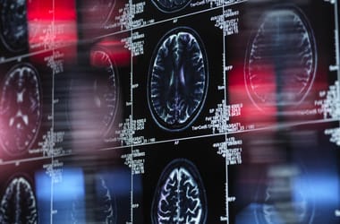 Segíthet a cukor az agynak, hogy küzdjön az Alzheimer-kór ellen