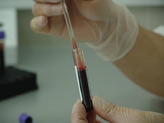 Egy 2400 forintos teszt segíthet megmondani, hogy lehet-e az embernek szívrohama vagy stroke-ja 10 éven belül