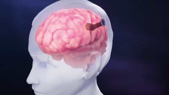 4096 elektródát ültettek egy emberi agyba, jelentős eredményt ért el a Neuralink riválisa
