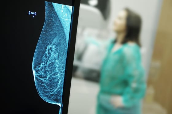 Kutatás bizonyítja: sokkal hatékonyabb a mellrákszűrés, ha a mesterséges intelligencia is részt vesz benne