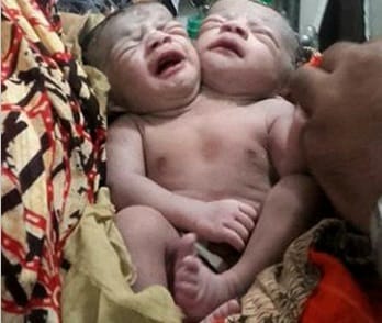 Meghalt a Bangladesben született kétfejű kislány