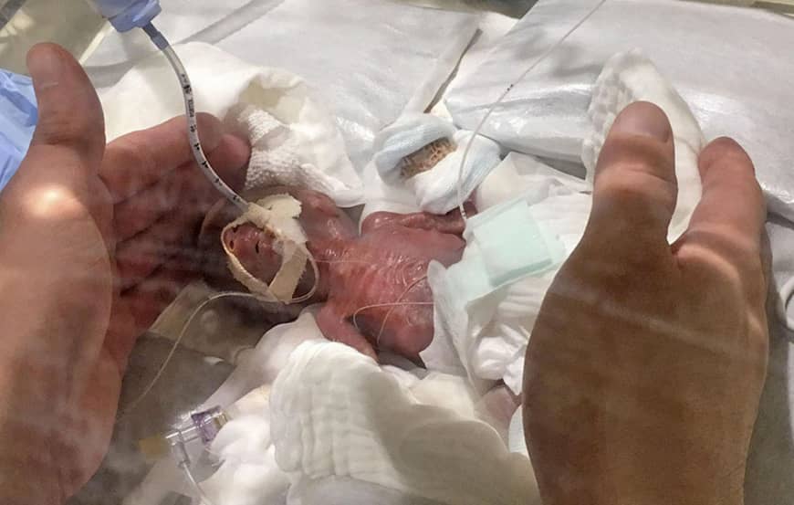 Két tenyérben elfért, olyan kis súllyal jött világra az újszülött, aki fél év kezelés után hazaengedtek a kórházból