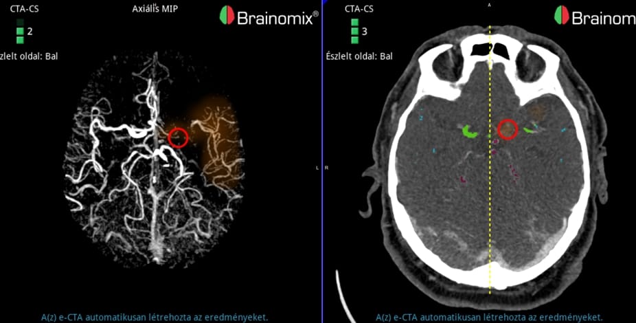 Stroke Magyarországon: amikor az idő halálos veszélyt jelent, akkor lép közbe a mesterséges intelligencia