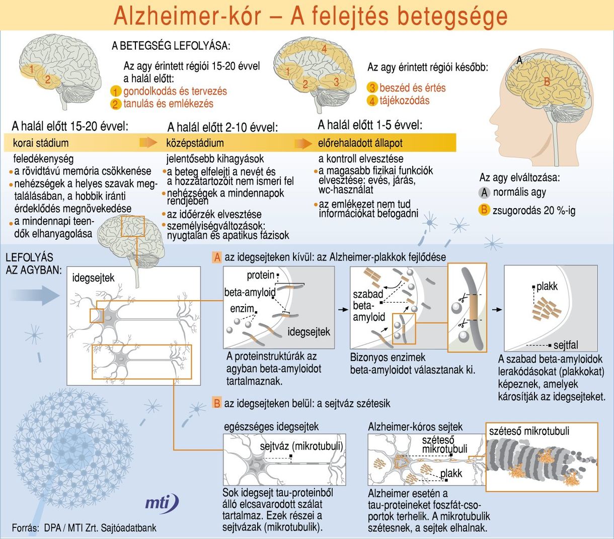 Az Alzheimer-kór összetéveszthetetlen tünetei 