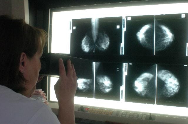 Elromlott mammográfiás készülék, hónapos várólisták, magyar egészségügy 2017