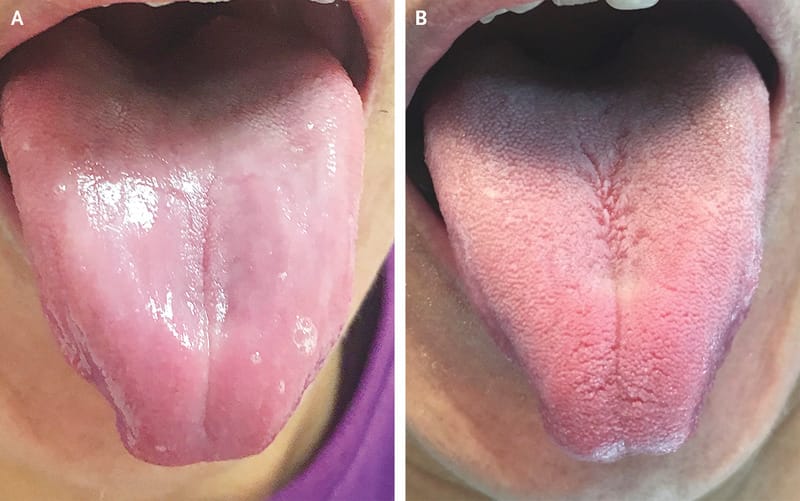 Drasztikus vitaminhiány miatt tűntek el az ízlelőbimbók egy férfi nyelvéről