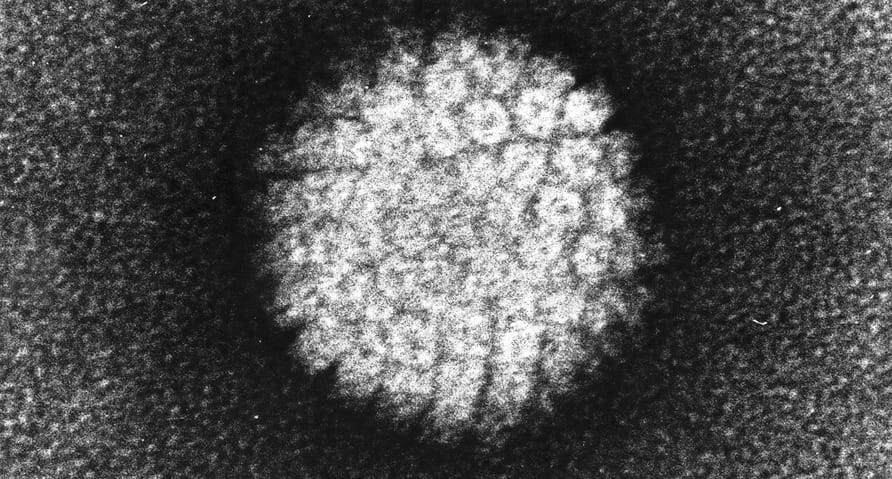 Vizeletvizsgálattal is ki lehet szűrni a HPV-vírust