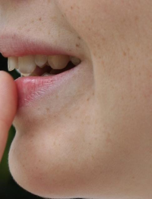 Napi tipp: így bánhatunk el a herpesszel