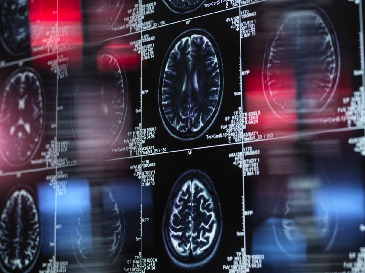 98,5%-os pontossággal diagnosztizálja az autizmust az új mesterséges intelligencia, sokkal korábban, mint eddig lehetséges volt