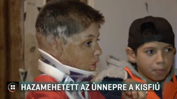 Otthon karácsonyozhatott a kisfiú, aki tavaly teljesen összeégett Sályon