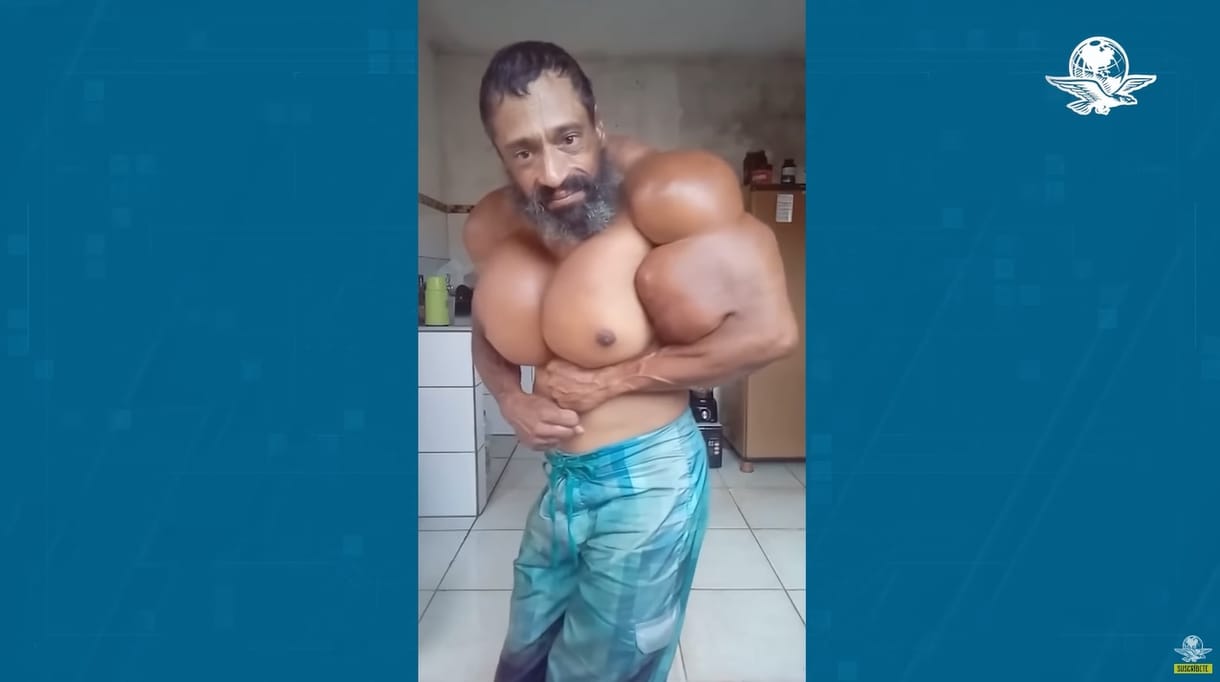 Szívrohamot kapott és meghalt a „brazil Hulk”, aki éveken át injekciózott olajat az izmaiba