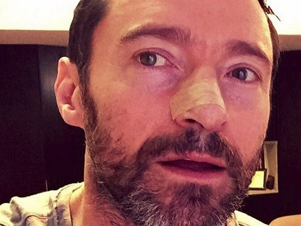 Hugh Jackmant ismét bőrrákkal műtötték