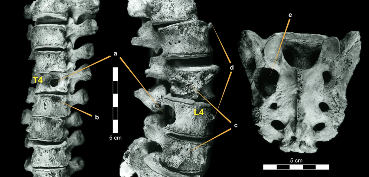 A mai embernél is megtalálható daganatot azonosítottak egy dinoszaurusz csigolyáján