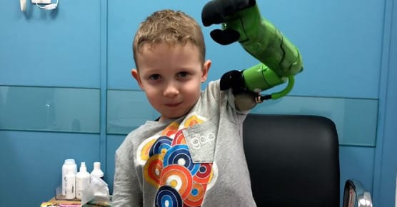 Műkarral ölelhette át testvérét a félkezű fiú