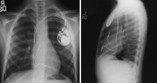 Semmelweis Egyetem: 1200 magyar szívben van visszahívott pacemaker