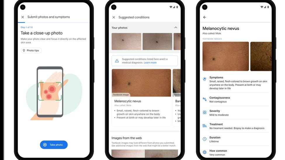 A Google új alkalmazása ránézésre megmondja, milyen bőrbetegsége van az embernek