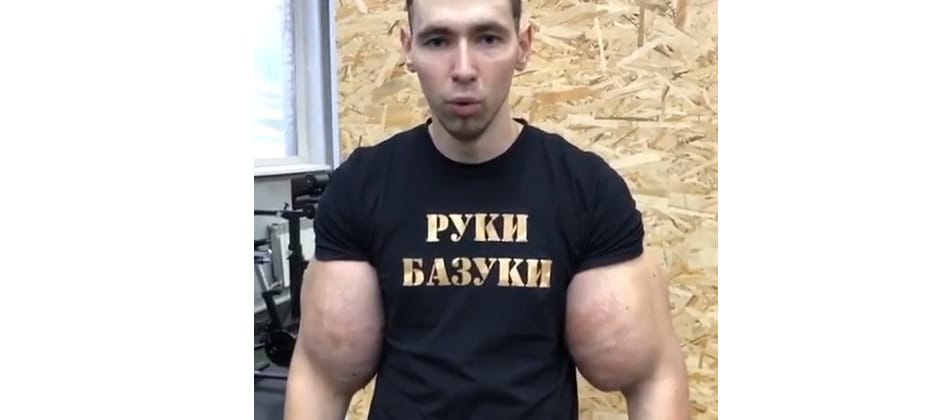 Otthon pumpálta fel az izmait, majdnem le kellett vágni mindkét karját