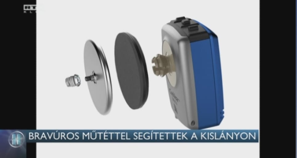 Bravúros műtéttel javították egy kislányt hallását Budapesten