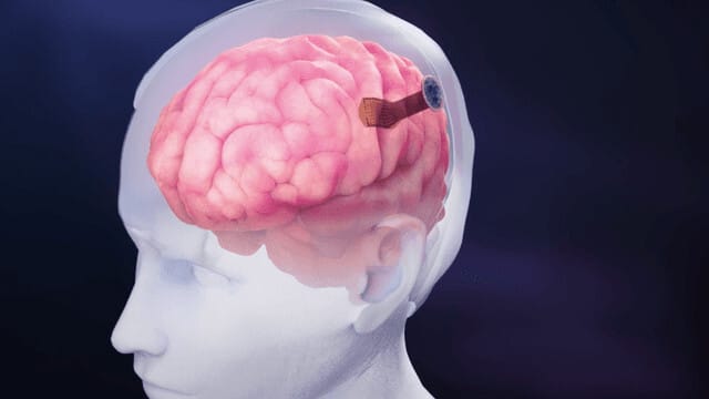 4096 elektródát ültettek egy emberi agyba, jelentős eredményt ért el a Neuralink riválisa