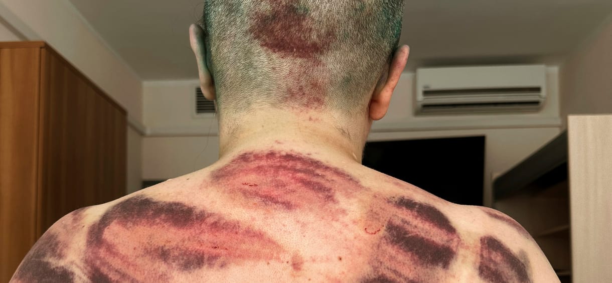 Megrázó képek jelentek meg az összevert orosz újságírónőről, akinek az ujjait is eltörték
