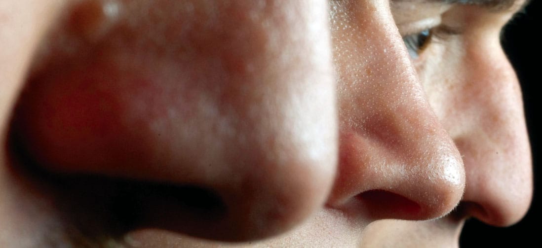 Az orrban korán felismerhető az Alzheimer-kór