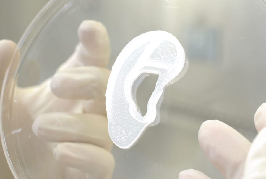3D-nyomtatással készült fület kapott egy 20 éves nő, ez volt a világ első ilyen műtétje